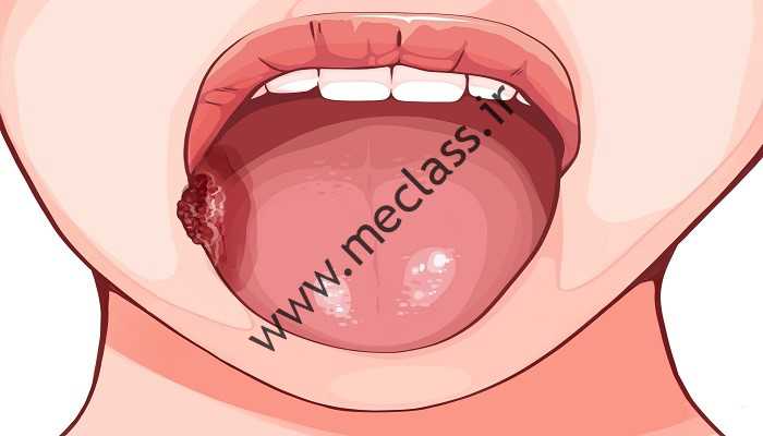زخمهای دهان؛  علت، تاکتیک ها و درمان در پزشک گوش و حلق و بینی